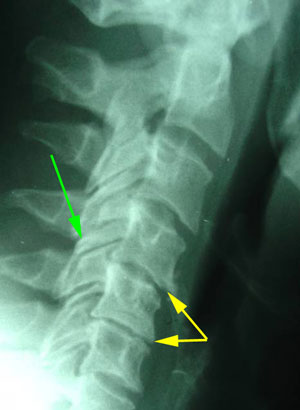 disc degeneration treated at Chiropractic Solutions