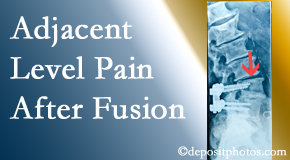 Chiropractic Solutions offers relieving care non-surgically to back pain patients suffering with adjacent level pain after spinal fusion surgery.