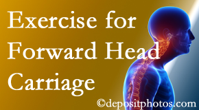 San Jose chiropractic treatment of forward head carriage is two-fold: manipulation and exercise.