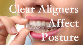 Clear aligners influence posture which San Jose chiropractic helps.