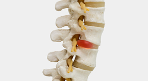 San Jose chiropractic conservative care helps even giant disc herniations go away