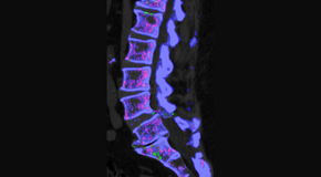 Chiropractic Solutions is aware that inflammatory spinal gout is a differential diagnosis to consider for patients who present with back pain and other spine related symptoms.