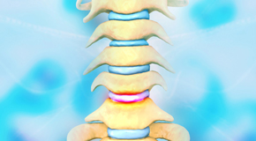 San Jose disc degeneration health