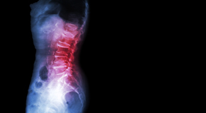 San Jose Chiropractic Care of Spondylolisthesis 