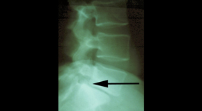 San Jose spondylolisthesis 