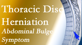 Chiropractic Solutions treats thoracic disc herniation that for some patients prompts abdominal pain.