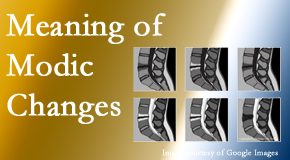 Chiropractic Solutions sees many back pain and neck pain patients who bring their MRIs with them to the office. Modic changes are often noted. 