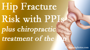 Chiropractic Solutions shares new research describing increased risk of hip fracture with proton pump inhibitor use. 