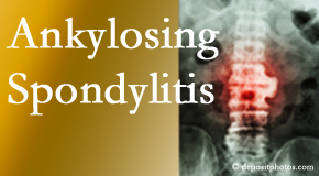 Ankylosing spondylitis is gently cared for by your San Jose chiropractor.