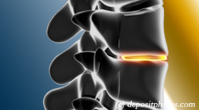 San Jose degenerative spinal changes 