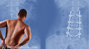 San Jose chiropractic relief for back pain after back surgery