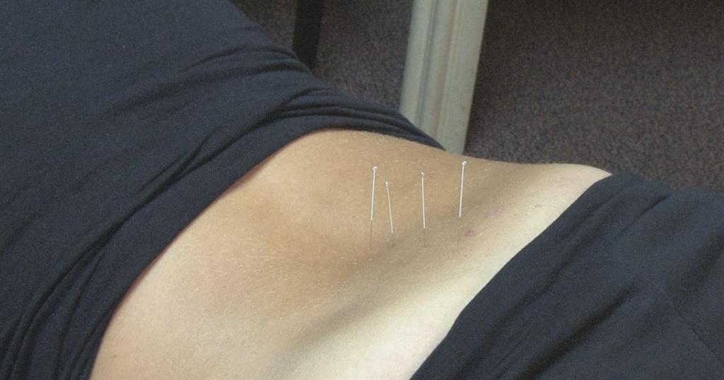 acupuncture image