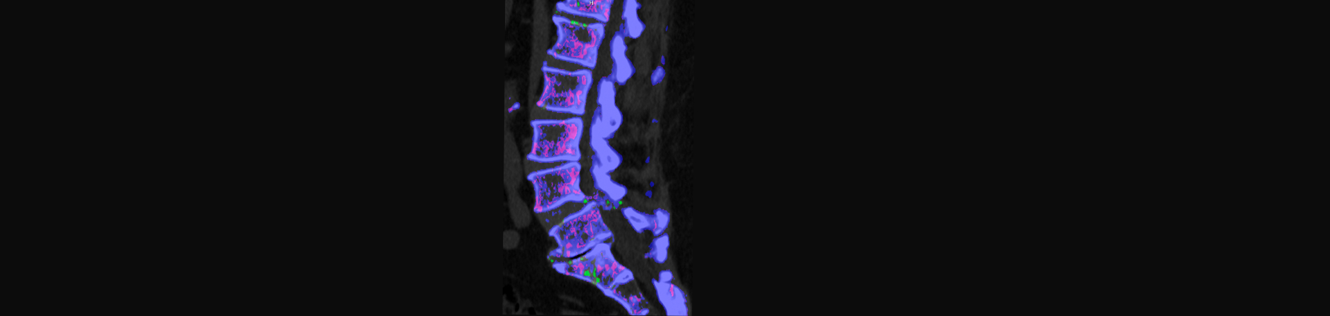 Chiropractic Solutions is aware that inflammatory spinal gout is a differential diagnosis to consider for patients who present with back pain and other spine related symptoms.
