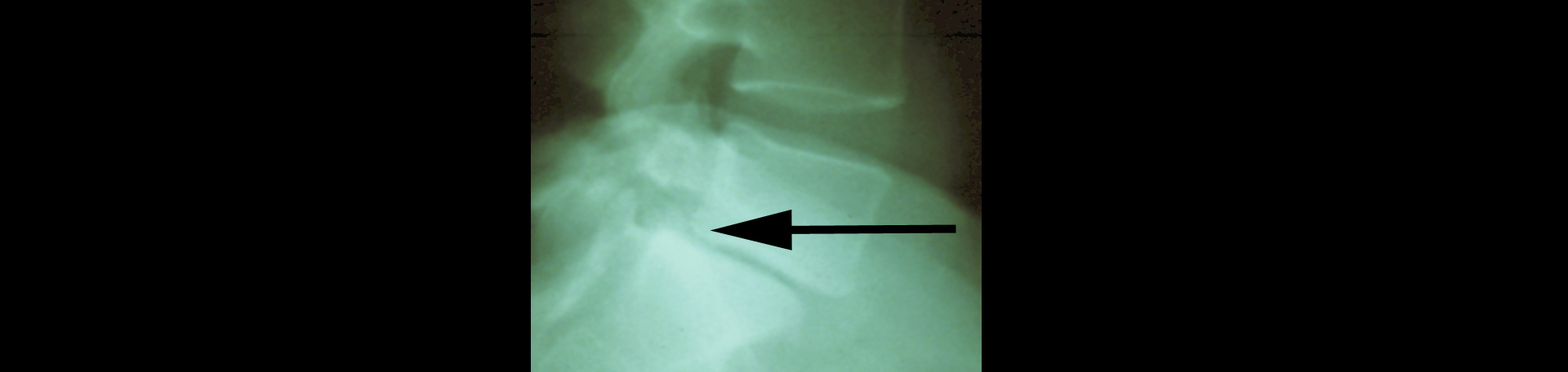 San Jose spondylolisthesis 