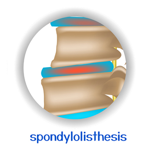 picture of San Jose spondylolisthesis
