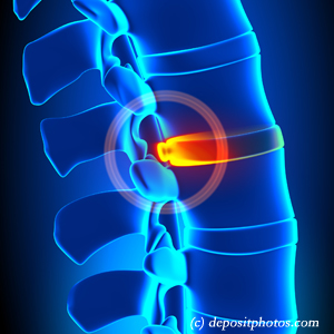 picture of lumbar San Jose disc herniation