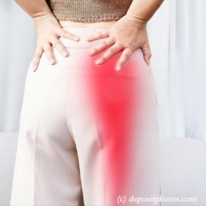 picture of San Jose leg pain, sciatica, lumbar radiculopathy