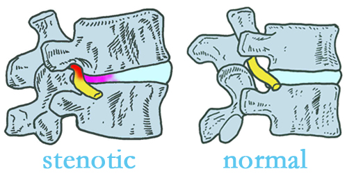 San Jose stenotic and normal spinal discs