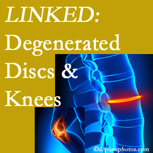 Degenerated discs and degenerated knees are not such strange bedfellows. They are seen to be related. San Jose patients with a loss of disc height due to disc degeneration often also have knee pain related to degeneration.  